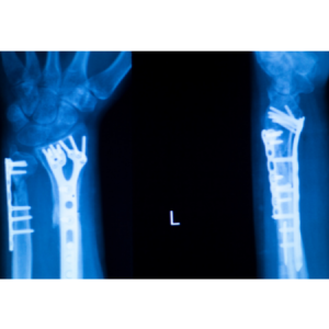 radiografia di ossa rotte